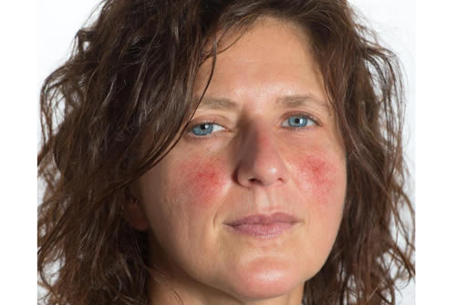 Exploring the Latest Rosacea Treatments and Their Effectiveness