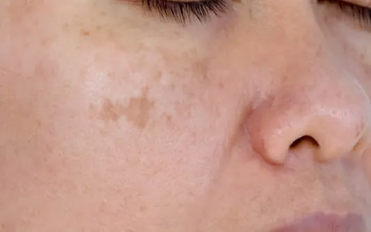 Age Spots vs. Sun Spots: What’s the Difference?