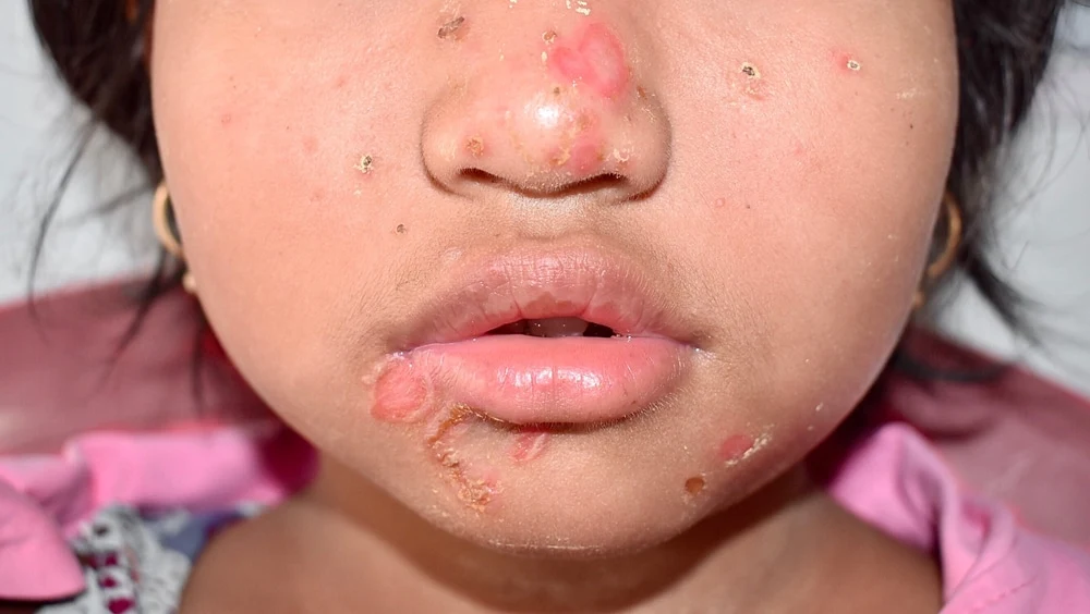 Impetigo: Tips for Treating and Preventing the Spread
