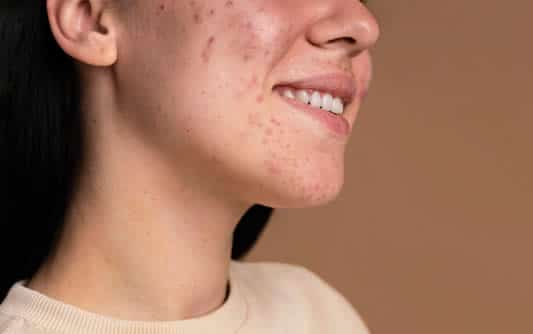 Cystic Acne: The Worst Form of Acne