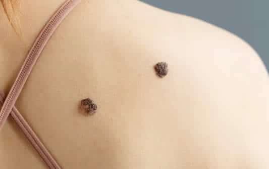Is there a Risk in Skin Tags?