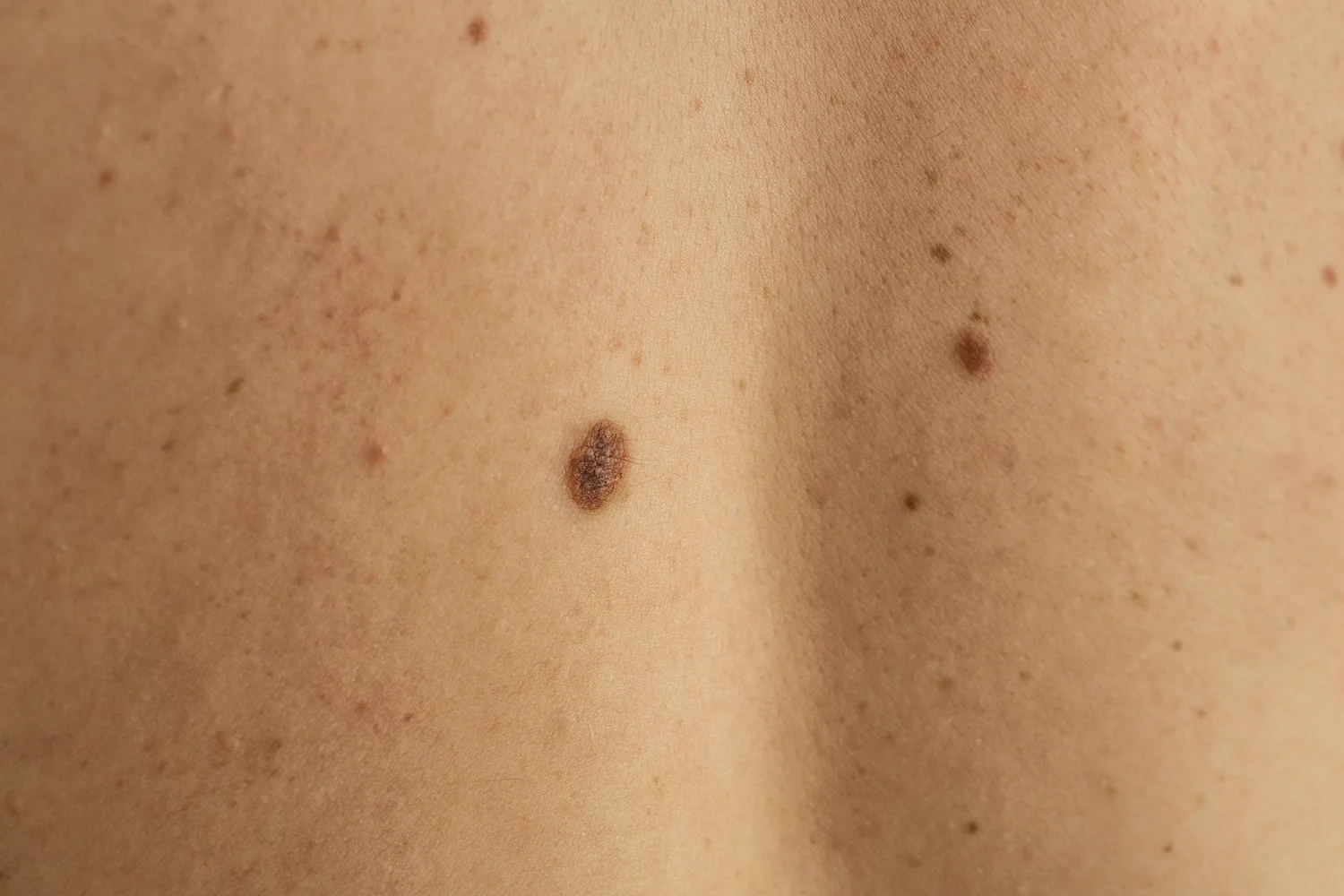 Several moles of different sizes on a person's back