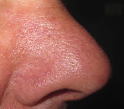 Nose with skin cancer 2 month after MOHS surgery