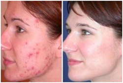 Photodynamic-therapy-2-before-after
