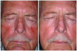 Photodynamic-therapy-3-before-after