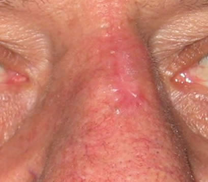 Skin cancer bridge of nose after MOHS surgery 2 months