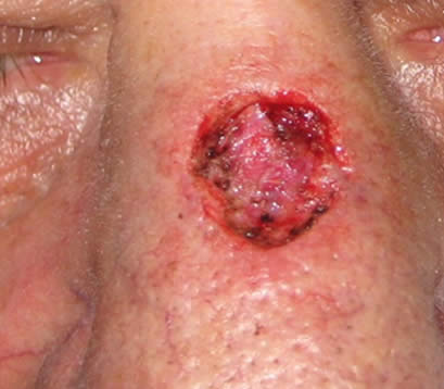 Skin cancer bridge of nose after MOHS surgery open wound