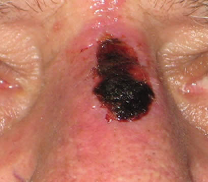 Skin cancer bridge of nose after MOHS surgery self healing 1 week