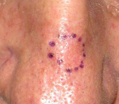 Skin cancer bridge of nose before MOHS surgery