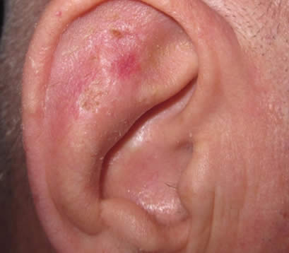Skin cancer on ear post MOHS surgery 3 weeks