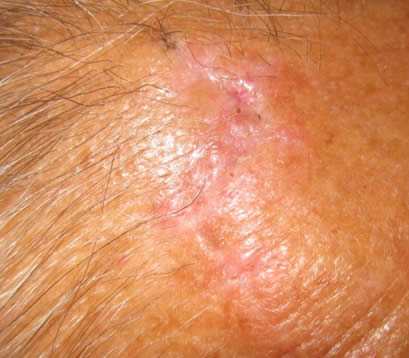 Skin cancer on right upper forehead after MOHS surgery 2 weeks