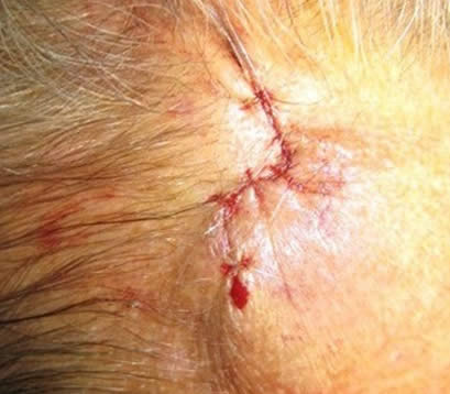 Skin cancer on right upper forehead after MOHS surgery closure
