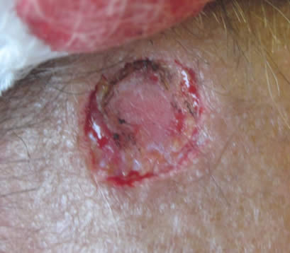 Skin cancer on right upper forehead after MOHS surgery open wound