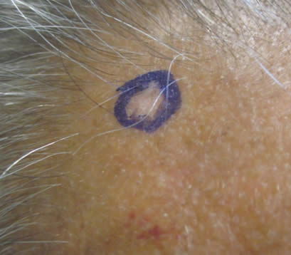 Skin cancer on right upper forehead before MOHS surgery