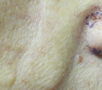 Skin cancer righ cheek after MOHS surgery 6 months