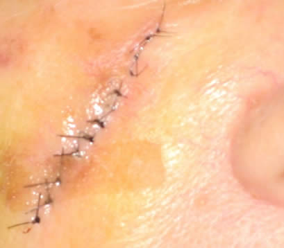 Skin cancer right cheek after MOHS surgery closure
