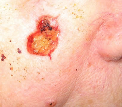 Skin cancer right cheek after MOHS surgery open wound