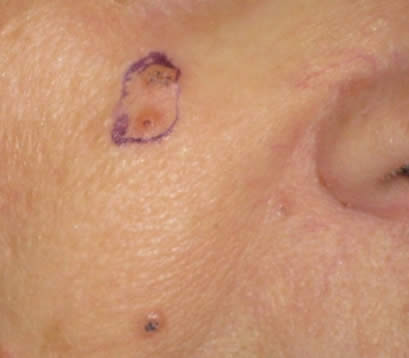 Skin cancer right cheek before MOHS surgery
