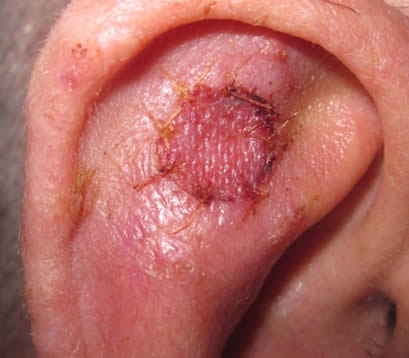 Skin graft on ear after MOHS skin cancer surgery 1 week