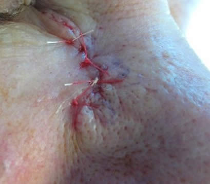 Wound closure on nose with skin cancer after MOHS surgery