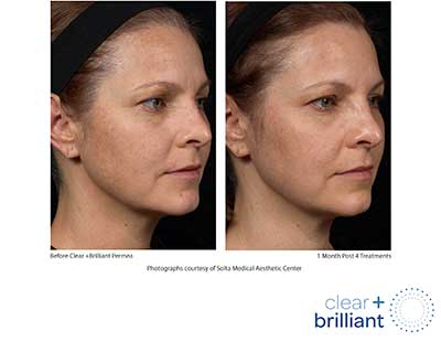 Patient 1 before and after clear brilliant laser