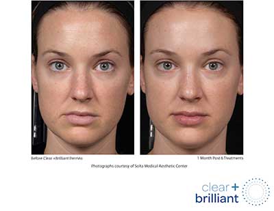 Patient 3 before and after clear brilliant laser