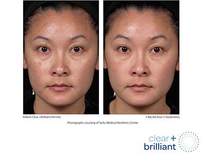 Patient 2 before and after clear brilliant laser