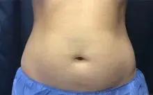 coolsculpting belly after