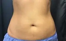 coolsculpting belly before