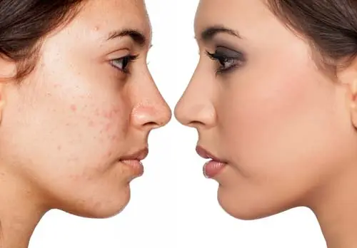 microneedling-with-php-before-after-2
