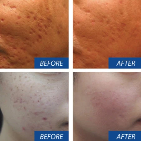 microneedling face before and after
