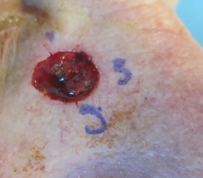 open wound on nose after MOHS surgery for skin cancer