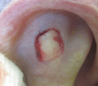 right ear after MOHS surgery open wound