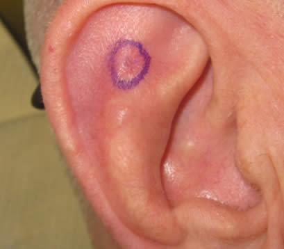 right ear close up open wound after MOHS surgery