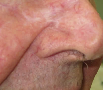 skin cancer after MOHS surgery on side of nose 2 month