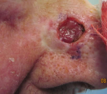 skin cancer after MOHS surgery on side of nose open wound