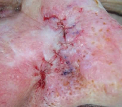 skin cancer after MOHS surgery on side of nose wound closure