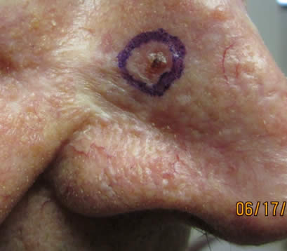 skin cancer before MOHS surgery on side of nose