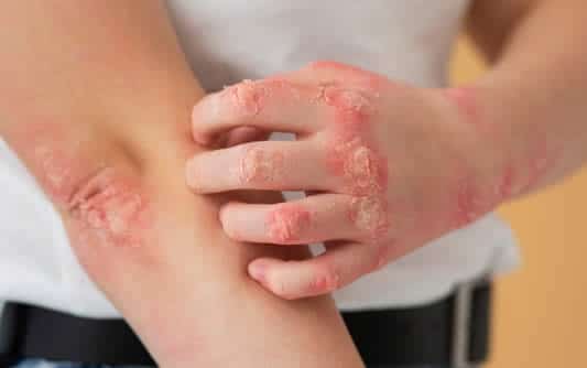 Hands of patient suffering from psoriasis