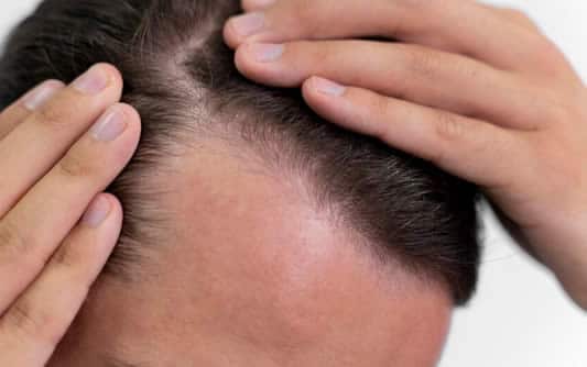 Suffering from Male Pattern Baldness? These Treatments Can Help