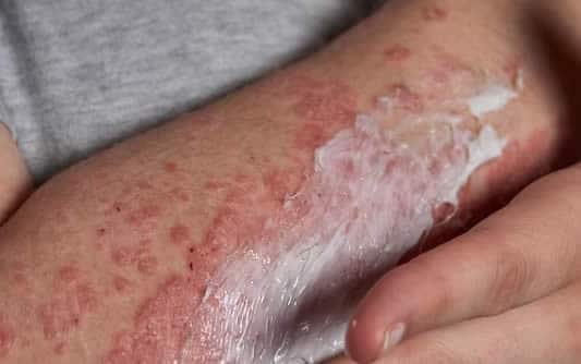 Applying moisturizer to skin with psoriasis