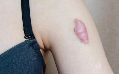 What causes keloid scars?