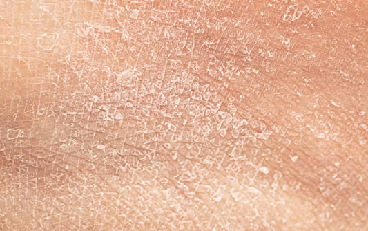 Dry skin: Who gets it and causes