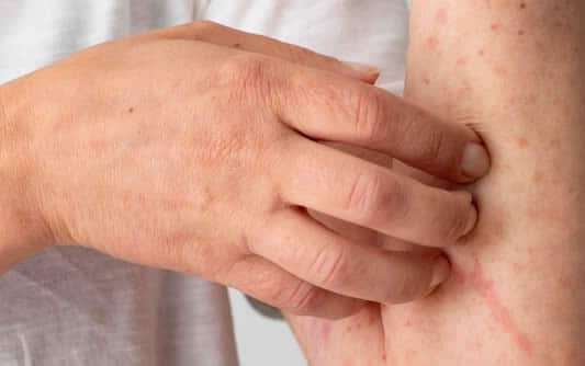 Understanding Dermatitis — Symptoms