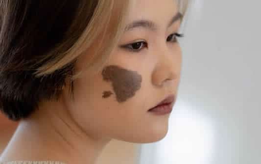Woman with Birthmark on Her Face