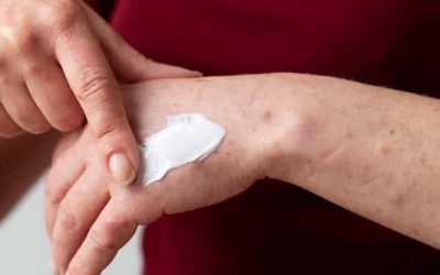 How to Live Better With Eczema