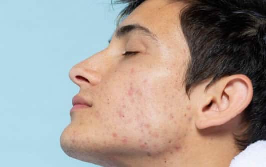 man with acne