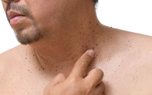 4 Reasons to Seek Professional Care for Skin Tag Removal