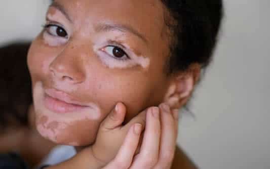 Look for These 5 Common Signs of Vitiligo
