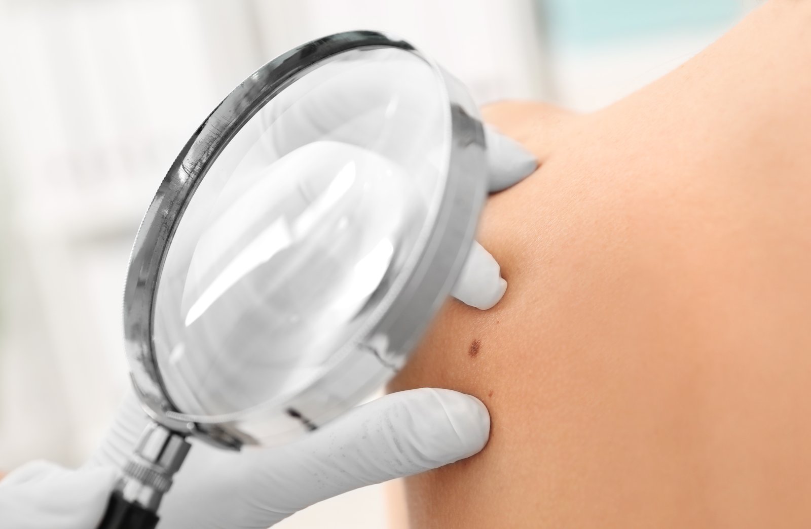 White-gloved hand holding a large round magnifier over a patient's shoulder during a skin exam